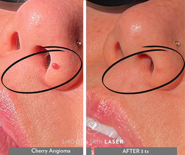 Treating Cherry Angioma and Rosacea with Laser